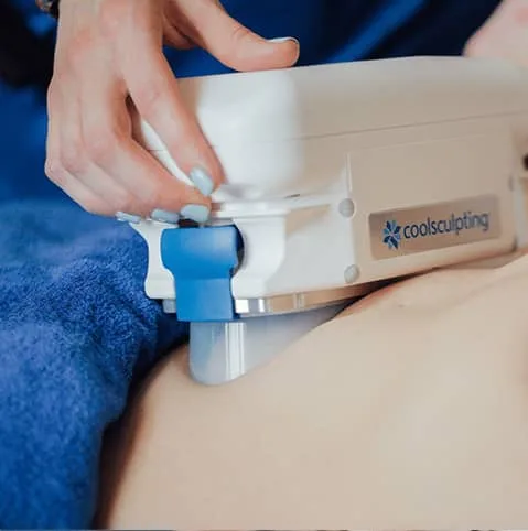 CoolSculpting abdomen treatment